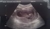 11w5d(12w2d)-2.jpg