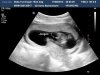 Baby Hunsinger 15wk 3dg20120517200326401.jpg