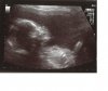 Hoofdje+rompje_20 wk echo.jpg