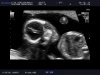 23377_20141224_FETAL-_HEART_0001.jpg