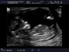 5542_20160308_NT-_ABDOMEN_0007-2.jpg