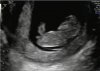 NUB 11wk.jpg
