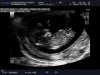 5890_20160822_NT-_ABDOMEN_0013.jpg