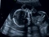 baby girl 19w2d_3.jpg