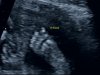 baby girl 19w2d_15.jpg