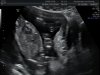 02_Echo_16w5d_02.jpg