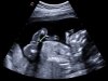 Baby Gender Pic 20 weeks crop.jpg