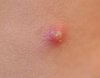 pustel-acne.jpg