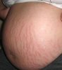 striae.jpg