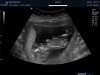 13 weeks echo (2) - bewerkt.jpg