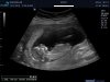 13 weeks echo (12) bewerkt.jpg