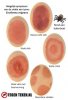 huiduitslag-erythema-migrans-lyme.jpg