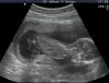 Kindje-_Huigen-S_20130105_ABDOMEN-_OBST_0002.jpg