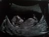Echo 12.2 weken 31-5-2012.jpg