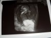3D ECHO 11 WEKEN, 5 DAGEN 5,8 CM GROOT 7 FEB 2013 (5) ZSP 2.jpg