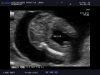 BABY_20130211_ABD-_OBST_0009.jpg