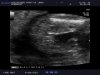 BABY_20130211_ABD-_OBST_0012.jpg