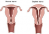uterine-septum-perth-wa.png