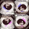 echo-Placenta-baby-jongen-meisje.jpg
