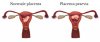 placenta-praevia-750x322.jpg