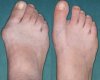 hallux_valgus.jpg