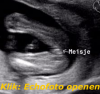 18weken_meisje.png