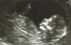 Ultrasound4.jpg