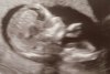 Medische echo 12w5d 230322 Close up.JPEG