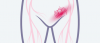 ExcellentKlinieken_lies-en-schaamstreek-390x170-1-1.png