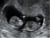 BABYECHONUB.jpg