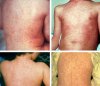 mazelen-measles-1.jpg