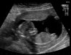 BABY-_POST-_4_20131206_ABD-_OBST_0031.jpg