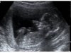 echo 15wk.jpg