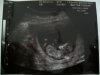 echo 11 wk en 5 dgn.jpg
