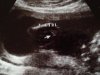 Baby A meisje.jpg