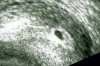 echo 5 weken 1 dag-zoom.jpg