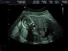 Baby jongen hersens.jpg
