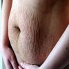 The-Best-Treatments-For-Old-Stretch-Marks.jpg