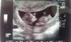 echo 12wk.jpg