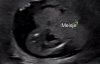meisje 15 wk.jpg