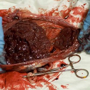 Placenta - 2 delen